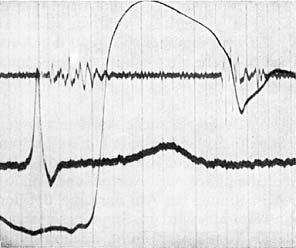 Untersuchung des Herzens a Abb. 8.9 Spaltung des 2. Herztons: oben: Herzschall über der Basis, Mitte: EKG-Abltg. II, unten: Karotispulskurve a Spaltung des 2.