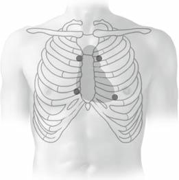 Untersuchung des Herzens 1 2 3 4 5 6 7 8 1 2 * 3 4 a b Abb. 8.3 Auskultation des Herzens: a Projektion der Herzklappen auf die ventrale Thoraxwand.
