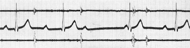 8.4 Auskultation des Herzens P QRS T Abb. 8.5 Schematische Darstellung der normalen Herztöne und ihre Beziehung zum EKG. HT = Herzton, a + b sind Haupt- und Nachsegment des 1. Herztons. 4. HT 1. HT 2.