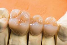 Zusätzlich bietet Ihnen das Bionische Prinzip der so gefertigten Arbeiten ein großes Maß an Sicherheit. Auch Ihre Zahnärzte werden von diesem neuartigen Zahnersatz begeistert sein.