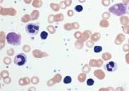 Abbildung 1: Blutausstrich bei CLL Im Blutausstrich sieht man bei der CLL typischerweise kleine und reif wirkende Lymphozyten mit einem schmalen Zytoplasmasaum und einem dichten Zellkern ohne klar