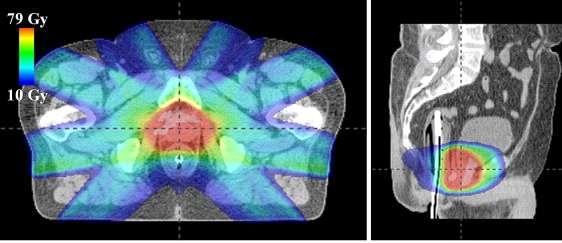 70-jähriger Patient mit Prostatakarzinom wurde mit alleiniger externer Strahlentherapie in IMRT- Technik mit 8 Feldern behandelt. Das Bild zeigt einen Isodosenplan (hier in n Colorwash-Darstellung).