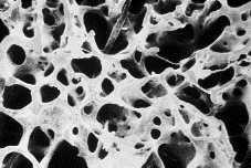 Definition der Osteoporose Osteoporose ist eine