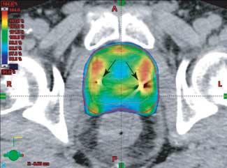 Abbildung 1: Verbesserte Konformität der Dosisverteilung durch intensitätsmodulierte Radiotherapie: Gute Übereinstimmung des Verlaufs des 95%-Dosis-Levels (blaue Einfärbung) mit dem Zielvolumen (rote