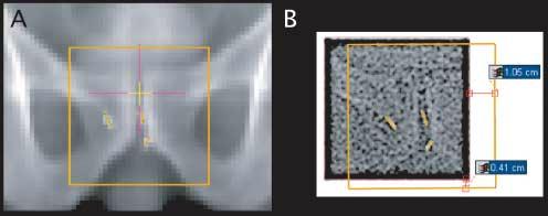 Abbildung 3: Digital rekonstruiertes Röntgenbild als Referenz für die Sollposition der Goldmarker (A).