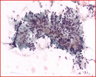 Pleomorphes Adenom Differentialdiagnose: adenoidzystisches Karzinom Basalzelladenom Myoepitheliom