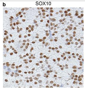 Hilfe bei DD onkozytärer Tumore Azinuszellkarzinom Immunzytochmisch positiv für DOG1, SOX10 normale