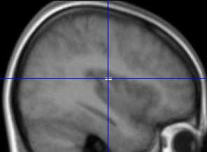 III Empirieteil: Ergebnisse Semantischer Gedächtnisabruf Während des semantischen Gedächtnisabrufs zeigte sich im Vergleich zum autobiographischen Gedächtnis (SM>AM) lediglich signifikante neuronale