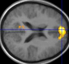 neuronaler Ebene, unabhängig von der Gedächtnisart. Es zeigte sich erhöhte neuronale Aktivierung im linken medialen präfrontalen Cortex (vgl. Tab.