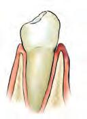 Nachweis von Parodontitis assoziierten Keimen VERLAUF EINER PARODONTITIS 1. Entzündung des Zahnfleisches (Gingivitis) Merkmale: Zahnfleischbluten Mundgeruch temperaturempfindliche Zähne 2.