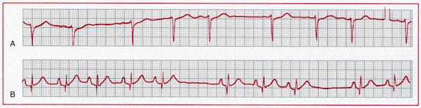 Sinuatrialer Block Ein erstgradiger SA-block ist im Oberflǎchen EKG nicht erkennbar. A: Bei einem SA-Block II.