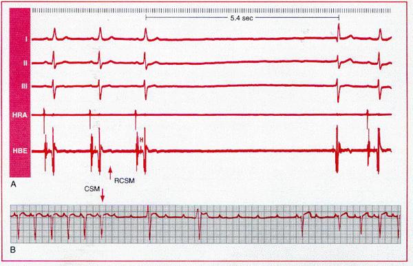 A, Mit mäβigem Druck der Karotissinus für 5 bis max. 10 sec. massiert. Ein pathologischer Befund liegt bei einer asystolie (5,4sec.), mit ventriculärem escape Schlag (wahrscheinlich fascicular) 5.