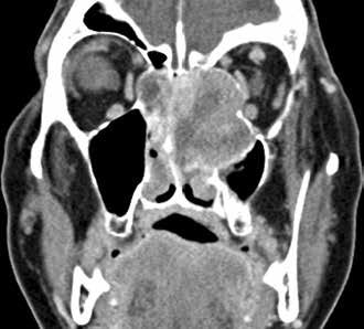 Bildessay 225 Abb. 14 69-jähriger Patient mit Ästhesioneuroblastom Kadish-Stadium C mit Infiltration des S. cavernosus und des Orbitatrichters.
