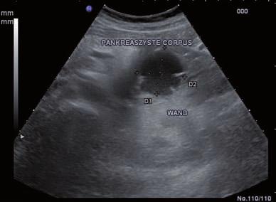 Ileus Der Darmverschluss ist im Ultraschall durch flüssigkeits- bzw. stuhlgefüllte, erweiterte Darmschlingen erkennbar.