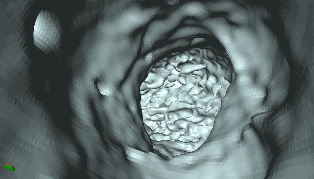3D Rekonstruktion Innere der aufsteigende Hauptschlagader; Blick auf Aortenklappe Quelle: PD Dr. C.