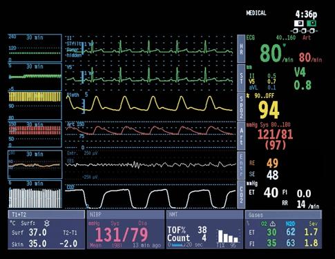 Wozu dient das Datex-Ohmeda Entropie-Modul? Anpassung der Dosis Die Entropie-Parameter korrelieren mit den Mengen bestimmter Anästhetika, die dem Patienten verabreicht wurden.