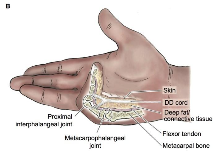 B: anatomische Landmarks einer betroffenen Hand; übernommen aus: The emerging role of Clostridium histolyticum collagenase in the treatment of Dupuytren disease; Alexis Thomas Ardeshir Bayat (19) 1.2.