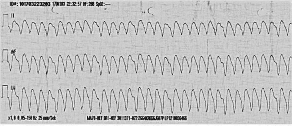 Monomorphe ventrikuläre Tachykardie Hämodynamisch stabil