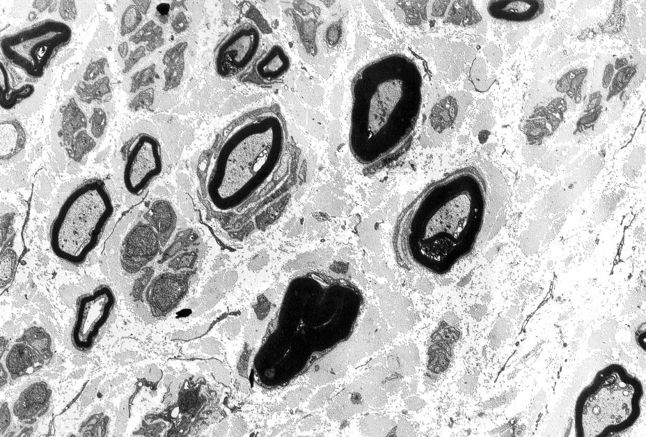 Das elektronenmikroskopische Bild zeigt mit weißem Pfeil gekennzeichnet eine sehr dicke Markscheide in einem geschrumpften Axon als Zeichen der axonalen Atrophie, daneben mit schwarzem Pfeil