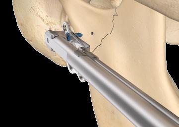 Einbringen der Implantate Zur Implantation der ersten Schraube wird zunächst der Handantrieb auf den Winkelschraubendreher gesteckt.