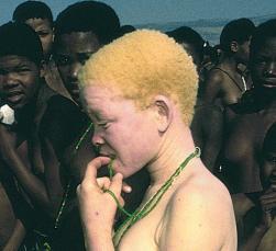 Galaktosämie Sichelzellenanämie Albinismus (Typ 1):