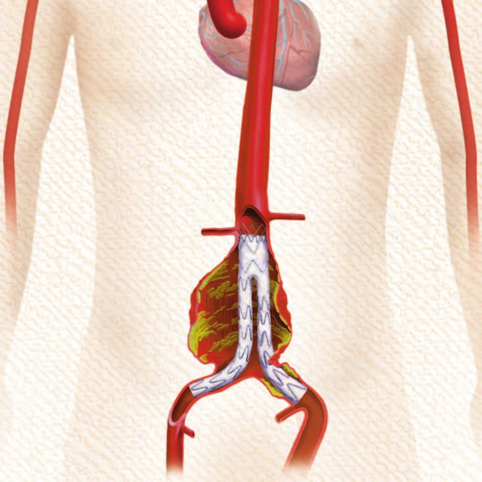 anschließend wieder entnommen wird. Der Applikationskatheter wird über ein Blutgefäß in der Leiste des Patienten eingeführt und zur Bauchaorta vorgeschoben (siehe Abbildung 4).