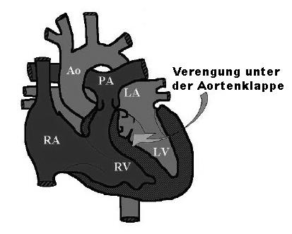 Vorlesung Kardiologie:, Angeborene Aorten/ Die Aorten- und (SAS) Dr.