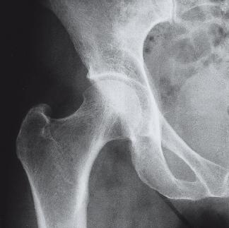 Möglichkeiten der Behandlung Diagnose erkrankter Gelenke Auf dem Röntgenbild ist die Knorpelschicht nicht erkennbar, sie zeichnet sich nur als Spalt zwischen dem Hüftkopf und der Hüftpfanne ab.