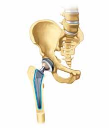 Zementierte Hüft-Endoprothese Ein schnell härtender Kunststoff, der so genannte Knochenzement (blau dargestellt), fixiert den Hüftschaft im Oberschenkelknochen und die Hüftpfanne im Becken.