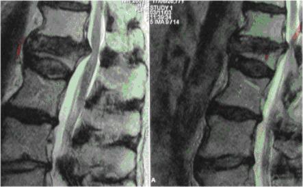 Brustwirbelsäule 05 Stabilisierungsoperation Sollte der Wirbelbruch zur Verlagerung von Knochenteilen in den Wirbelkanal geführt haben, die eine Druckwirkung am Rückenmark
