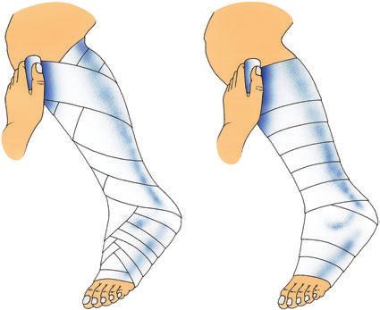 Die konservativen Behandlungen Kompression Die Kompressionstherapie wird bei starker Schwellung des Beins, bei offenem Bein (Geschwür = Ulkus) und nach Varizenbehandlung durchgeführt.