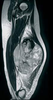 vorwiegend diaphysär und selten breiter als 3 bis 4 cm. Ewing-Sarkom Die zweite große Gruppe der primär ossär lokalisierten Tumoren ist die der Ewing-Sarkome.