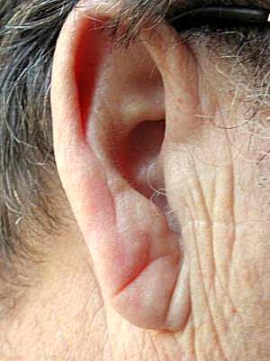 Relation of Diagonal Ear Lobe Crease to the Presence, Extent, and Severity of Coronary Artery Disease