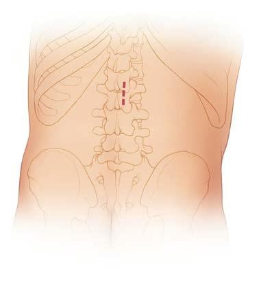 (Abbildung 1). Paraspinalen Muskeln unilateral retrahieren. Die Zwischenwirbelgelenke nicht beeinträchtigen.