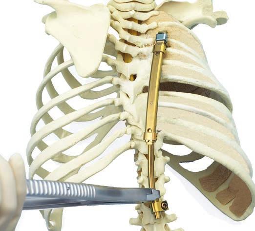 Primäroperation 6e. Lumbale Verlängerung auf das kaudale Implantat ausrichten Instrumente 314.070 Sechskantschraubenzieher, klein, 2.5 mm, mit Nut 388.