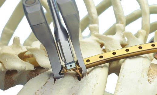 7c. Kaudale Implantate einbringen Instrumente 388.453 oder Haltezange für Verschluss-Halbring, 388.465 für VEPTR 388.461 Haltezange für Verschluss-Halbring oder Rippenhalterung 388.