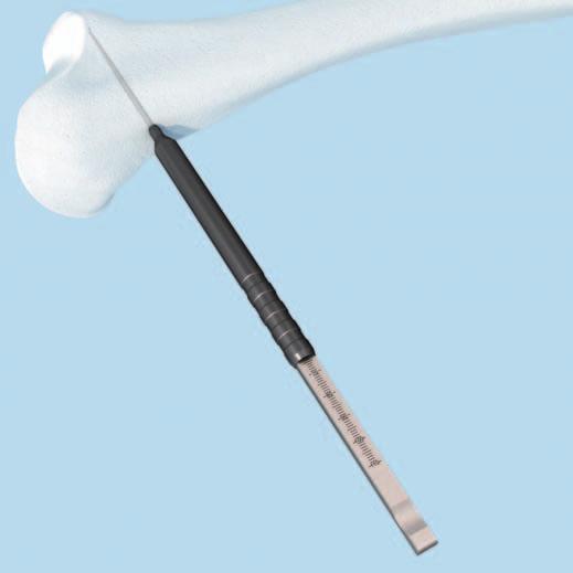 2 Osteotomietiefe bestimmen Instrument 03.108.026 Tiefenmessgerät für Osteotomie-Zielgerät Den 2.8 mm LCP Spiralbohrer entfernen.