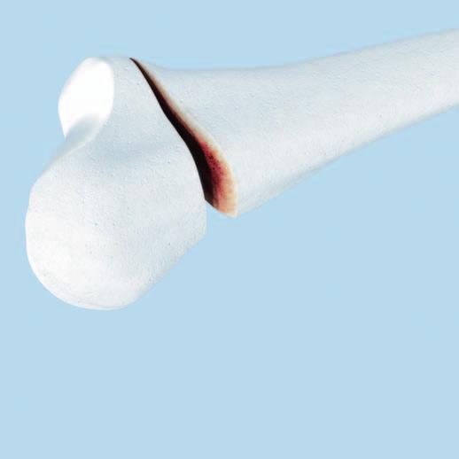 distalen Drähte und unterhalb der proximalen Drähte mit oszillierendem 1,25 mm