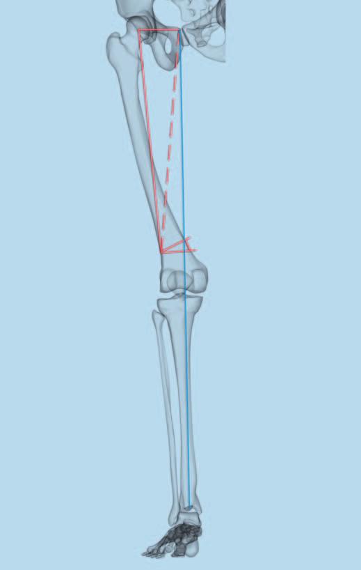 Präoperative Planung Mit der präoperativen Planung für die Umstellungsosteotomie soll die Grösse des zu entfernenden Knochenkeils bei einer zuklappenden Osteotomie bestimmt werden.