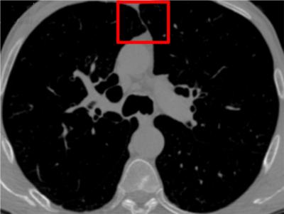 Segmentierung in CT-Daten 123 Abb. 2. Beispiel zur Trennung der Lungenflügel. (a): Axiale Schicht eines CT- Datensatzes inkl. einer markierten Beispielregion.