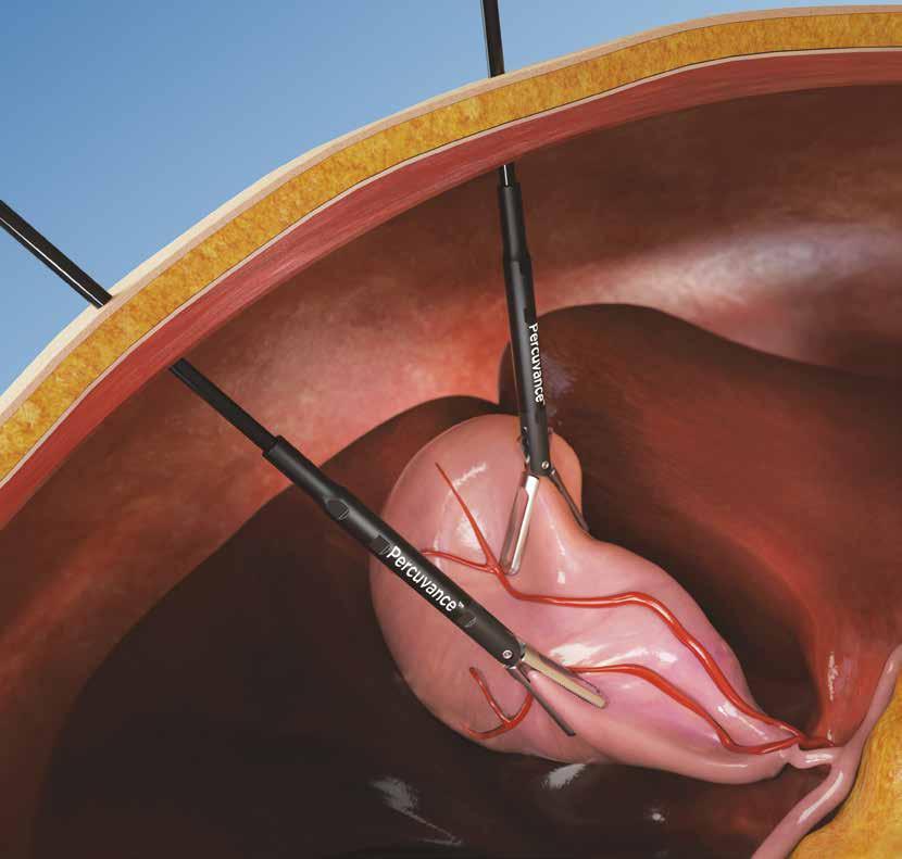 Das 2,9 mm Percuvance System für die perkutane Chirurgie