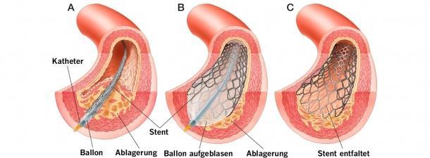 KARDIOLOGISCHE EMPFEHLUNGEN Implantation eines BM-stents 1-3 Monate duale