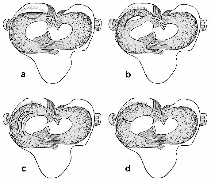 Abb. 5: Verschiedene Formen der Meniskusverletzung: a) Ablösung des Kaudalhornes von der Gelenkkapsel, b) Korbhenkelriss, c) Longitudinalrisse, d) Transversalriss (in Anlehnung an PAATSAMA, 1952)