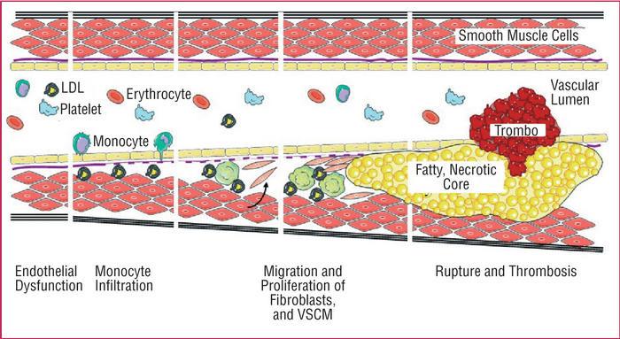 LDL cholesterol -- atherosclerosis