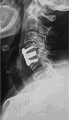 Bandscheibenprothese Versteifung Operation Foraminotomie: Es wird durch einen hinteren Zugang zum betroffenen Segment nur das vorgefallene seitliche Bandscheibengewebe entfernt.