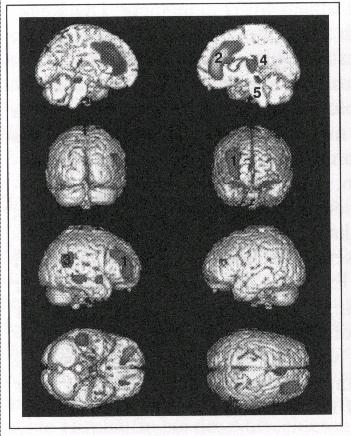 Störungstheorien Dimension: Intensität Funktionelle Bildgebung: Alertness Einfache visuelle Reaktionsaufgabe evoziert Aktivität im Cingulum (2), im präfrontalen (1) und im parietalen