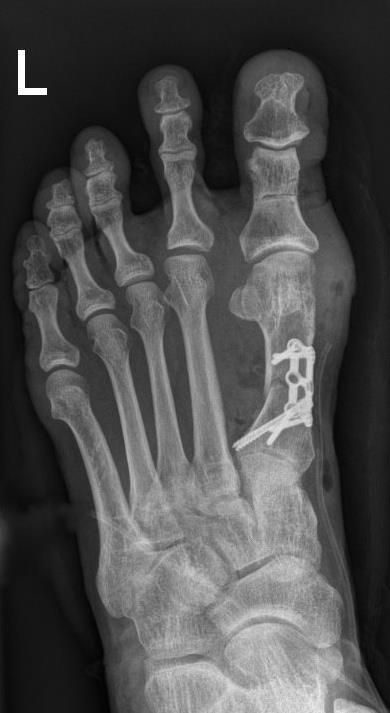 Unterpunkt Fußchirurgie: Hallux rigidus Es handelt sich um einen zunehmenden Verschleiß des Großzehengrundgelenkes. Durch die Arthrose wird eine Einsteifung des Gelenkes begünstigt.