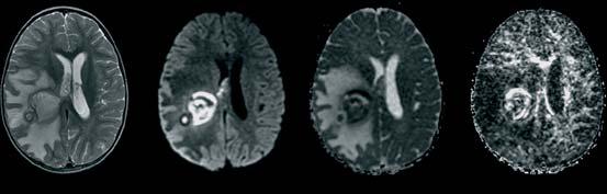 2b: Axiale T1-FSE, DWI- und ADC-Bilder einer akuten, subsegmentalen Arteria cerebri media Ischämie links. Das zytotoxische Ödem ist DWI-hyperintens und ADC-hypointens. Abb.