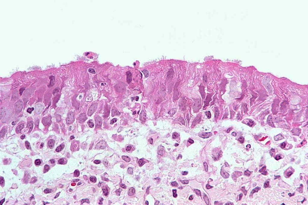 Störung Mukoziliäre Clearance die Zilien scheinen auf zahlreichen Zellen reduziert zu sein statt dessen