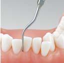 P11L REF: Z217409 Linksgebogen MODELL: P20 REF: Z217420 anwendbar bei ein- und mehrwurzeligen Zähnen